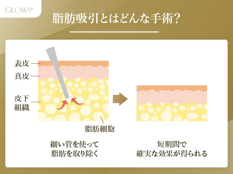 脂肪吸引とはどんな施術？